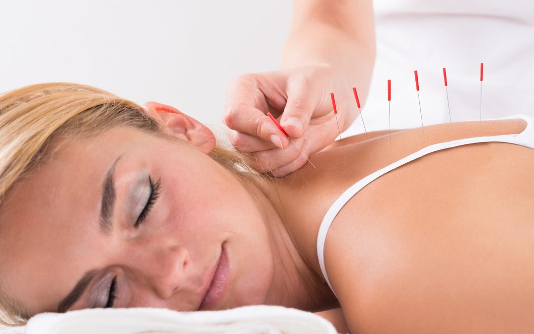 Picture of a woman getting Acupuncture in Daphne AL, acupuncture daphne AL, acupuncture fairhope AL