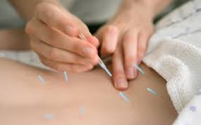 acupuncture foley gulf shores