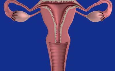 Causes and Treatments for PCOS and How Acupuncture Can Help