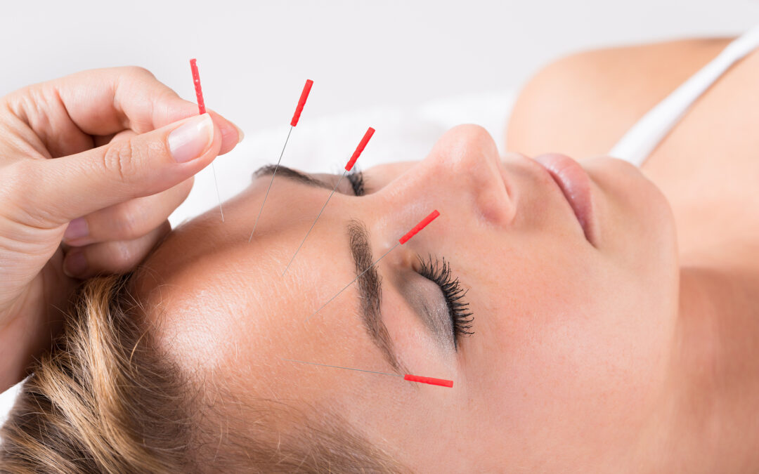 Acupuncture in Daphne: Benefits and Uses